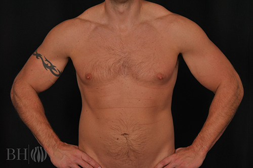 Male Breast Reduction Before & After